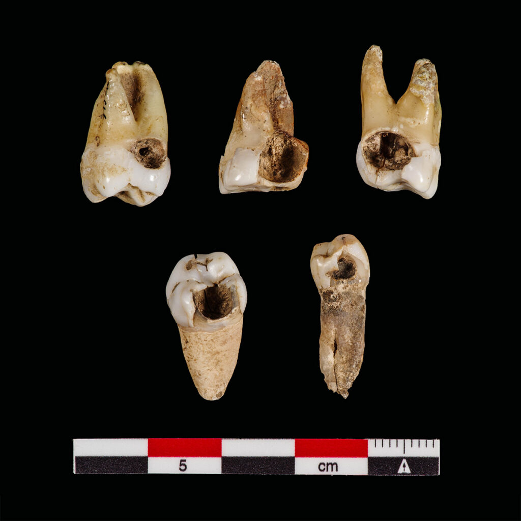 Human Teeth with Caries | Historic Jamestowne